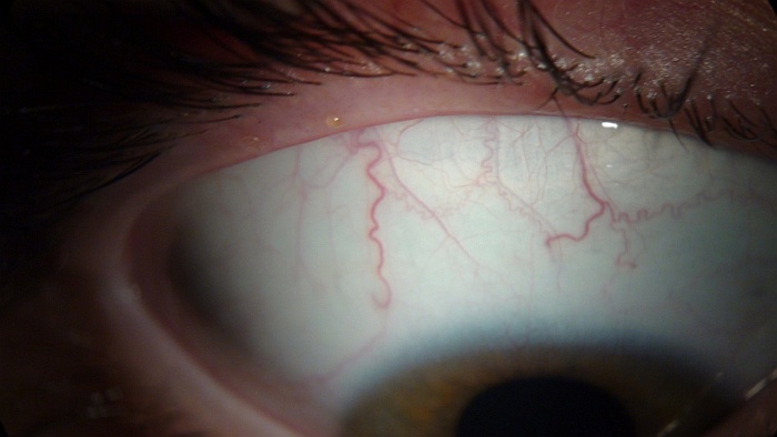 Блефарит – симптомы, причины, диагностика и лечение блефарита глаза век в клинике «Будь Здоров»